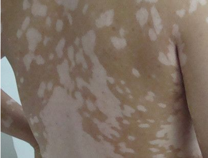 女性治疗白癜风的方法.jpg